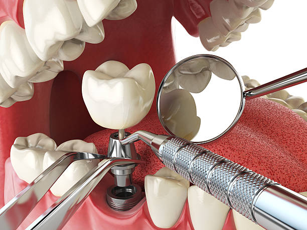 Best Emergency Dentist for Lost Fillings or Crowns in Miramar, FL
